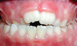 Crossbite of Back teeth